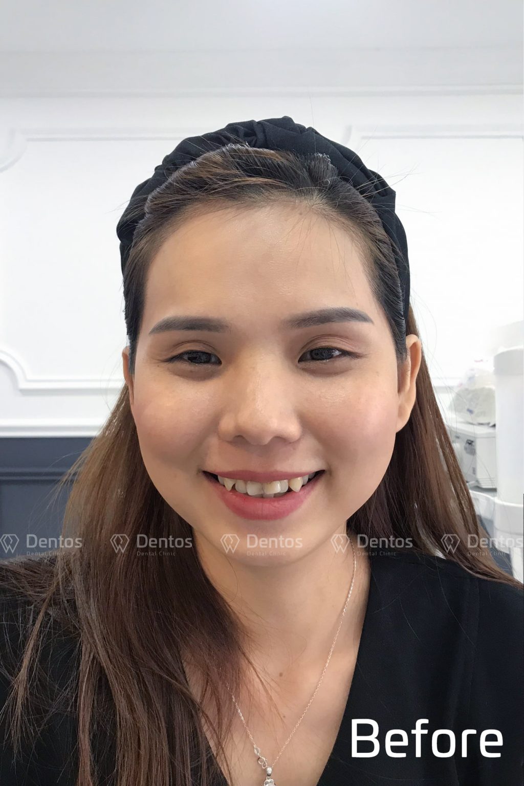 Trước khi bọc răng sứ thẩm mỹ